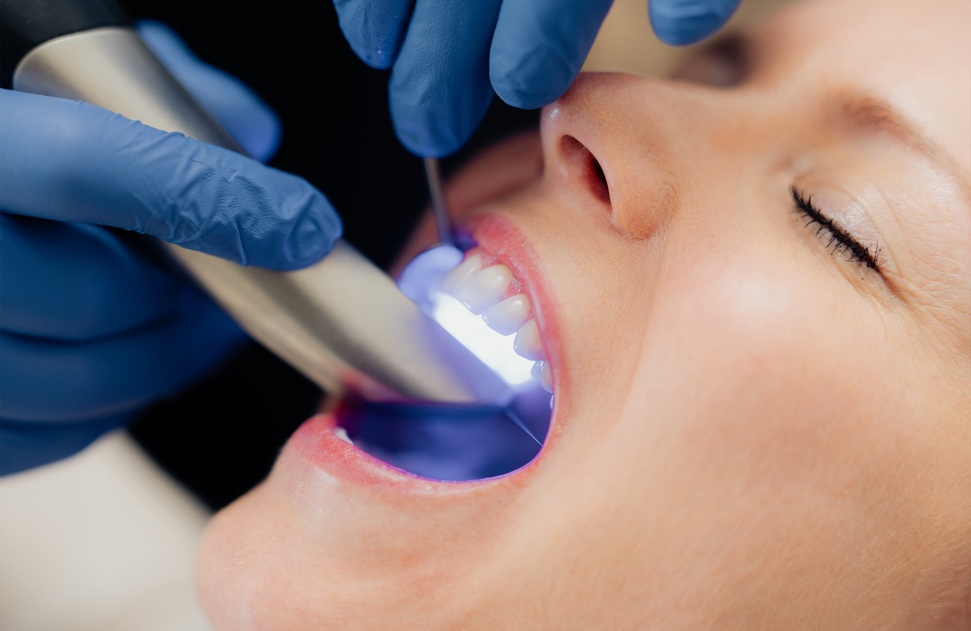 Mittels Primescan – dem Intraoralscan – lassen sich die Zähne berührungslos erfassen